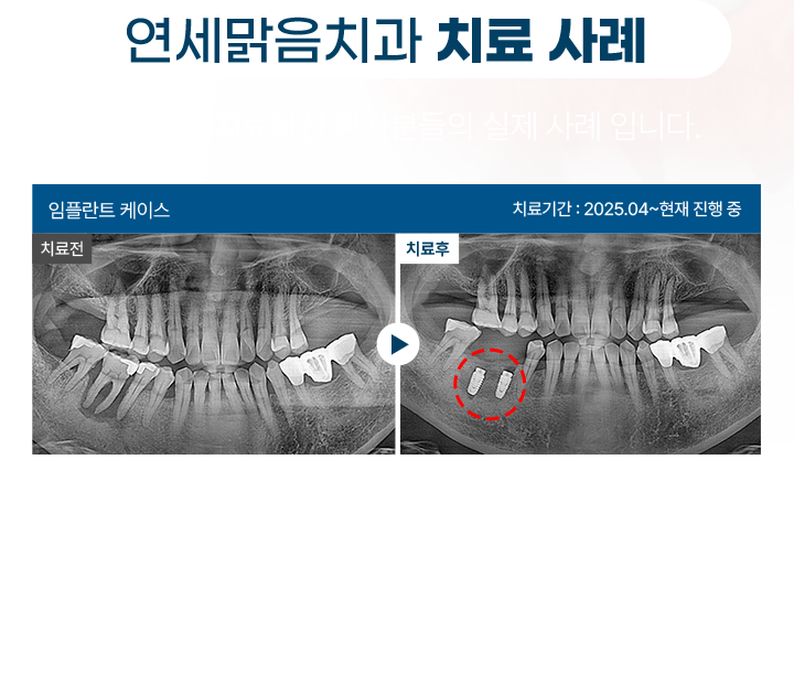 mo_임플란트치료사례_01