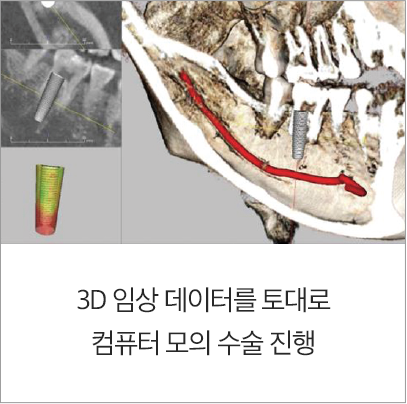 임플란트-진행과정1